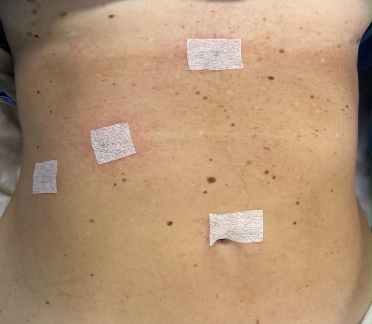 Abdome após cirurgia por videolaparoscopia, com incisões milimétricas